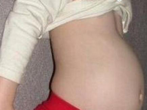 Bào thai ngày một lớn trong bụng bé gái 4 tuổi khiến cha mẹ chết lặng