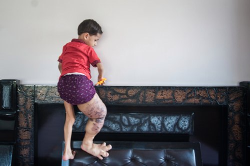 Bé 3 tuổi mang dị tật chân vẫn ngỡ mình là siêu nhân khiến nhiều người xót xa