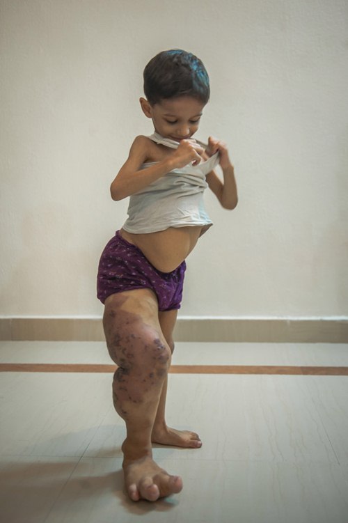 Bé 3 tuổi mang dị tật chân vẫn ngỡ mình là siêu nhân khiến nhiều người xót xa