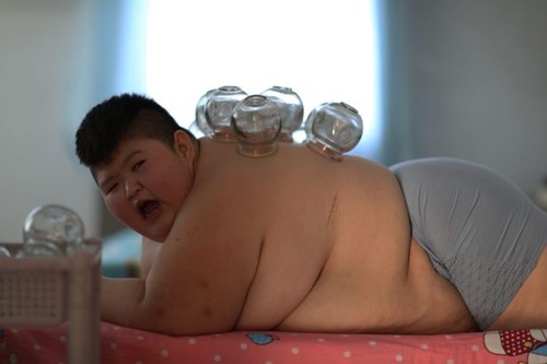 Hình ảnh cậu bé 11 tuổi đau đớn điều trị béo phì khiến người lớn rùng mình