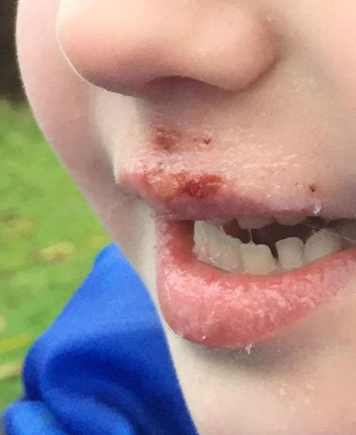 Người mẹ không ngờ vật dụng quen thuộc này khiến con 6 tuổi bị bỏng rộp chảy máu môi