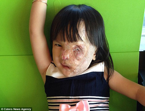 Cuộc sống mới của bé việt mang khối u nửa khuôn mặt được nhà hảo tâm người mỹ cứu sống