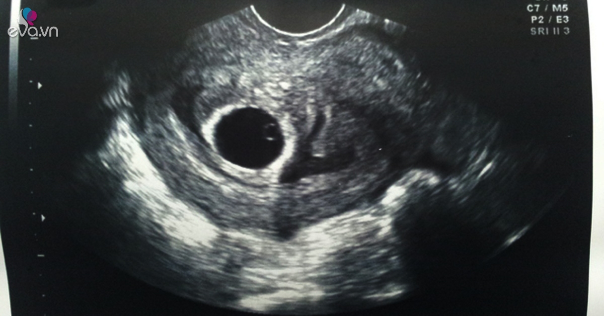 Thai nhi 5 tuần là khoảng thời gian quan trọng đối với sự phát triển của bé. Hình ảnh siêu âm sẽ cho bạn những thông tin hữu ích về thời điểm con phát triển như thế nào, giúp bạn luôn an tâm và yên tâm trong quá trình mang thai.